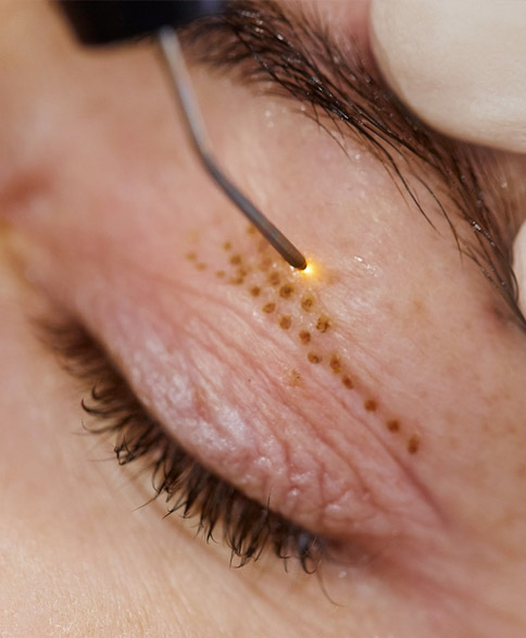 traitement du visage par plasma à mettet saint-gérard en province de namur à coté de pontaury